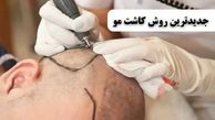 معرفی جدیدترین روش های کاشت مو در ایران