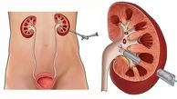 بهترین دکترهای سنگ کلیه در مشهد